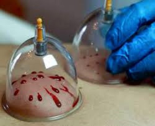 hijama cupping